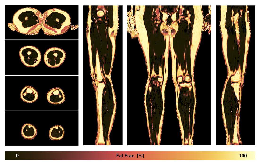 The fat fraction of the lower extremity obtained from the dixon reconstruction for muscle water fat quantification.